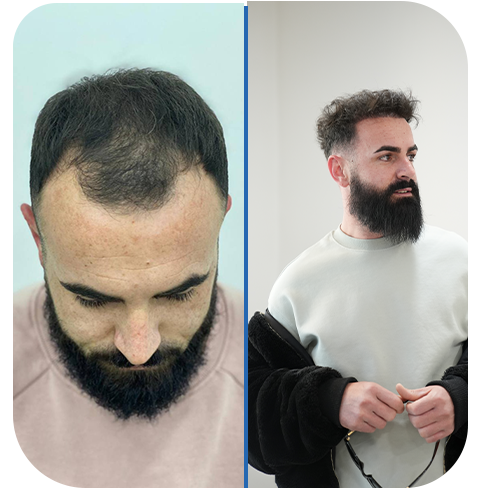 Hair Transplantation